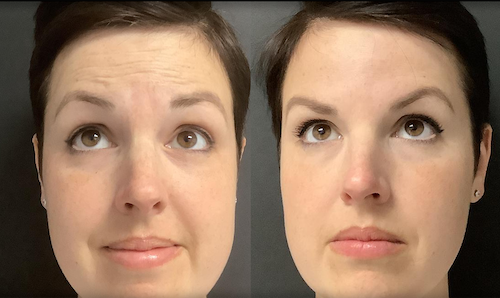 Forehead Wrinkle Reduction Mississauga Oakville Before After
